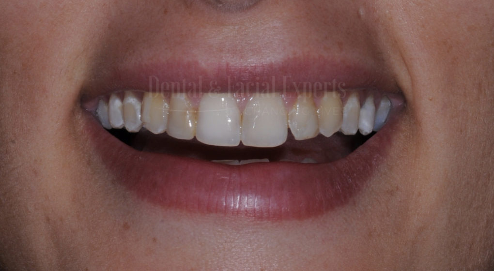 caso niaz facetas apos tratamento ortodoncico.001